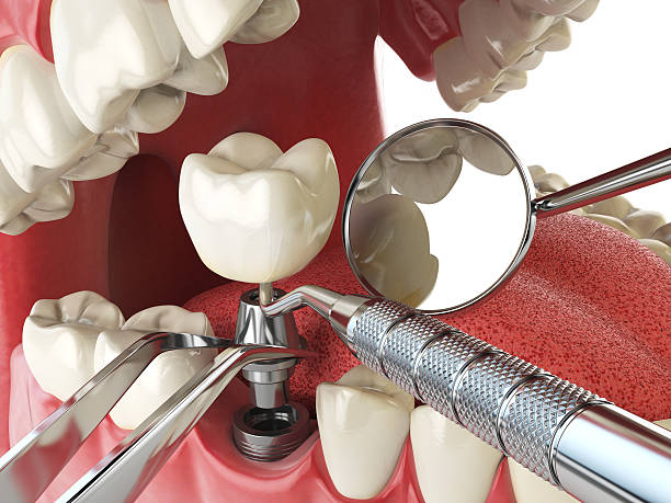 Best Emergency Dental Care for Broken or Chipped Teeth in Phenix City, AL